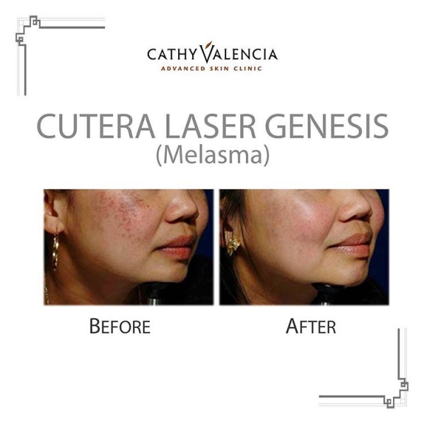 CV LASER TREATMENTS Cathy Valencia